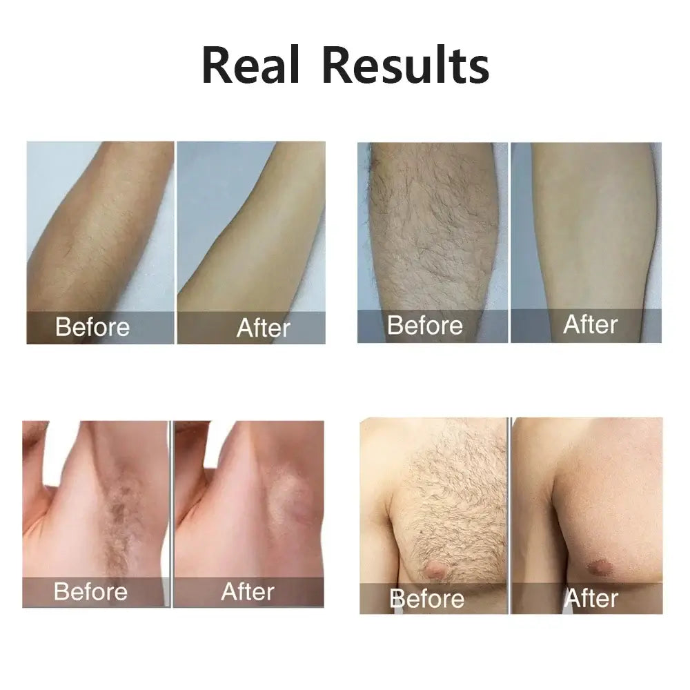 Before and after results of GlowSilk IPL Hair Removal on arms and underarms showing effective hair removal.